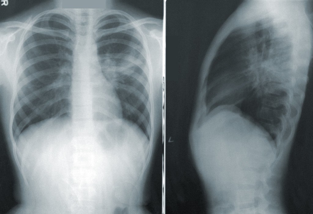 what should you not do when you have pneumonia